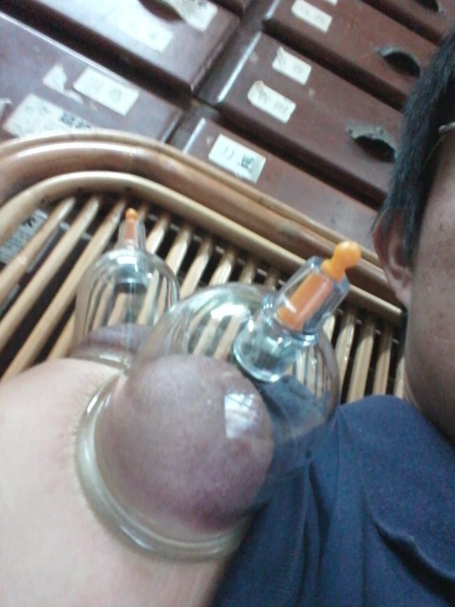 拔火罐